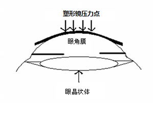 角膜塑形用硬性透气接触镜说明书编写指导原则（2020年修订版）（2020年第47号）(图1)